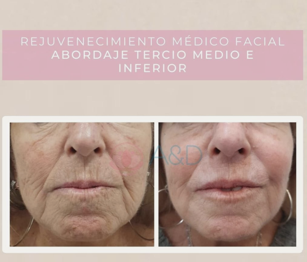 Laser diodo rejuvenecimiento facial sale