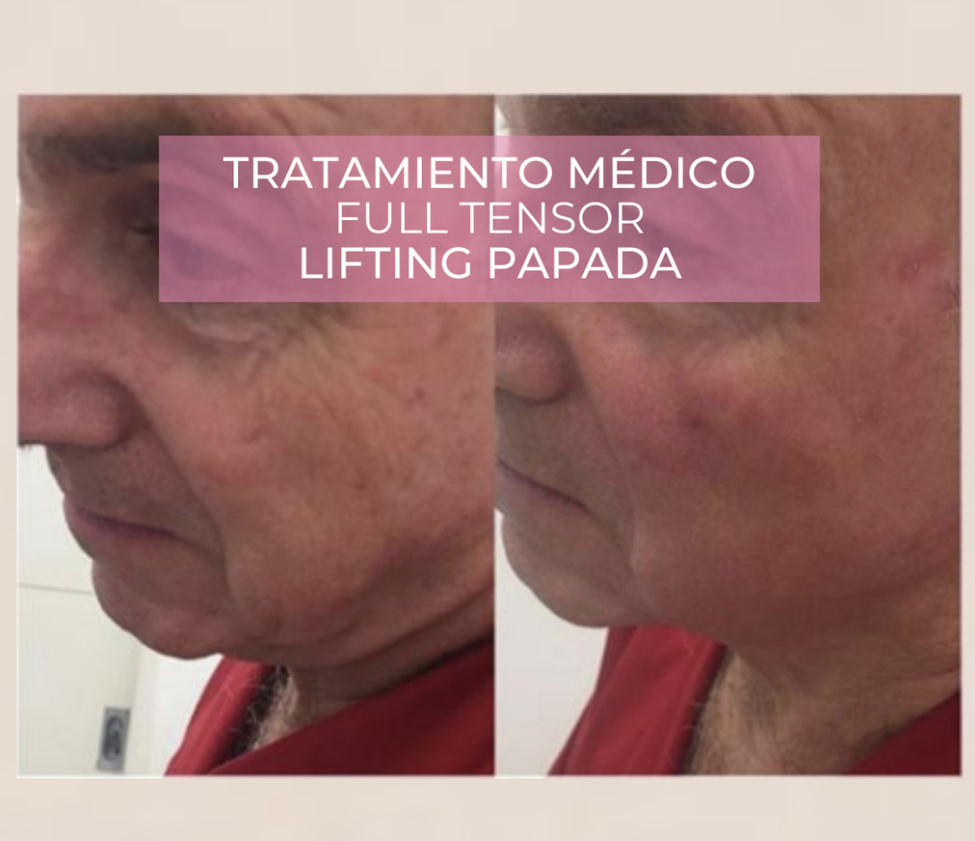 laser lumiia diodo 980 facial dra andrea mamani