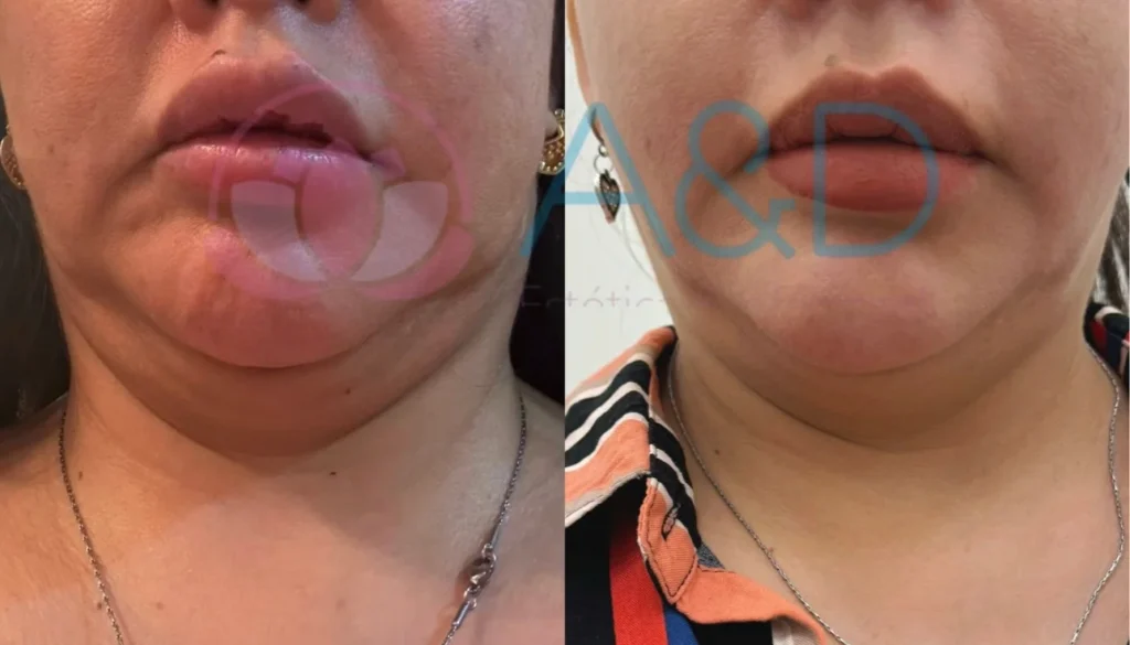 Tratamiento con ENDOLIFT® Endoláser: Rejuvenecimiento facial y corporal