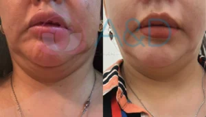 Endolift para cuello y papada: Rejuvenecimiento sin cirugía