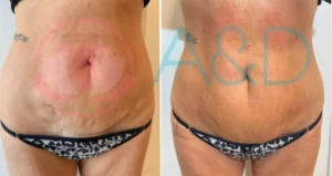 Endolift en abdomen: firmeza y definición sin cirugía con la Dra. Andrea Mamani