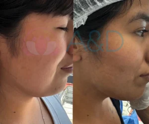Lifting facial sin cirugía: La solución con Endolift para rejuvenecer tu rostro
