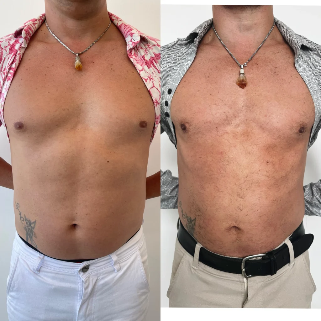 endolift en el abdomen
