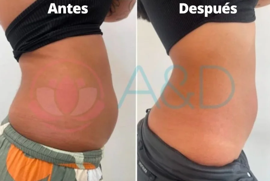 endolift en el abdomen antes y después