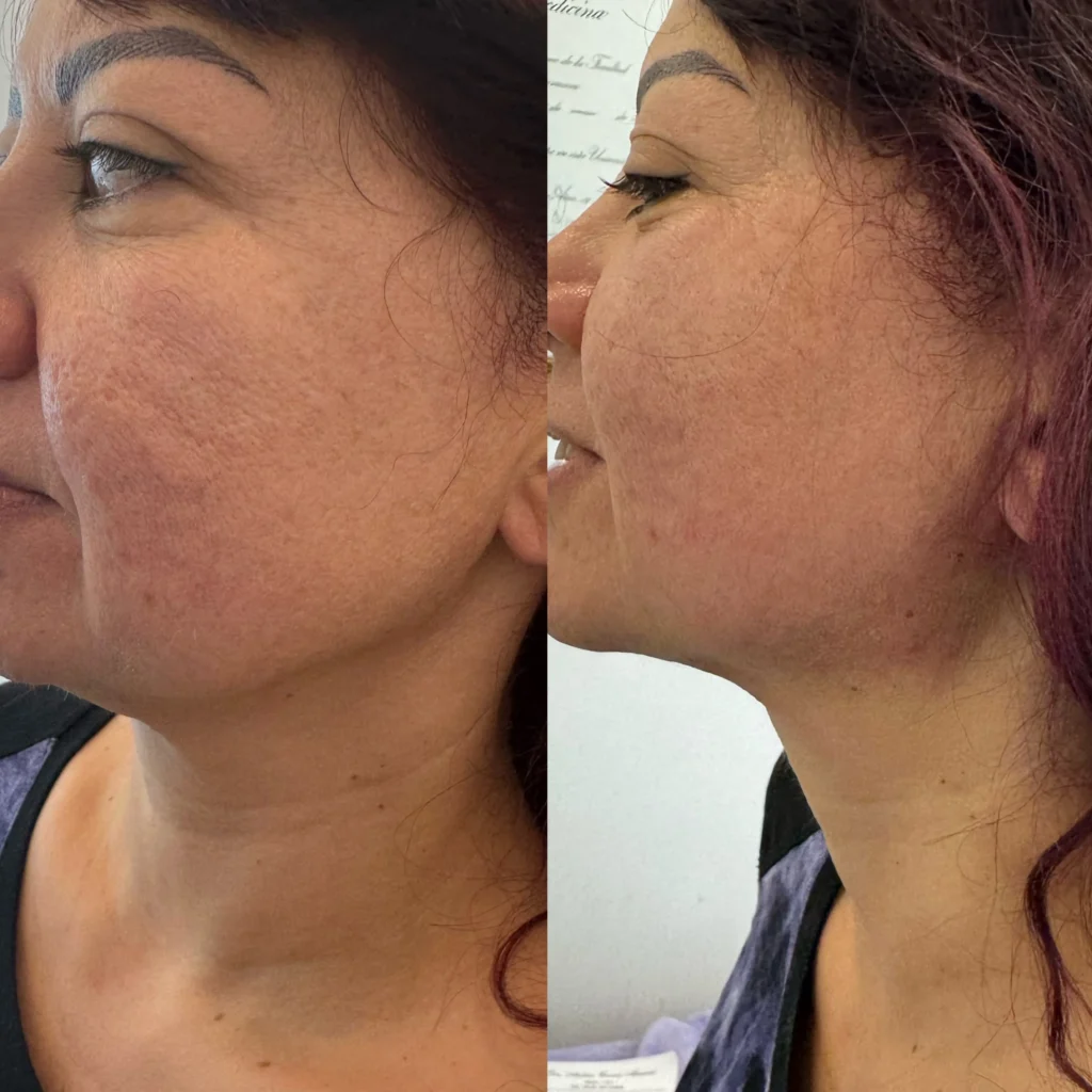 endolift mandibula y cuello