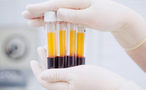 Curso de Plasma Rico en Plaquetas con la Dra. Andrea Mamani