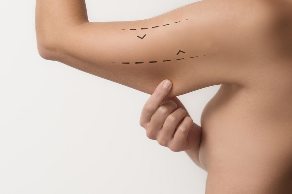 endolift en brazos